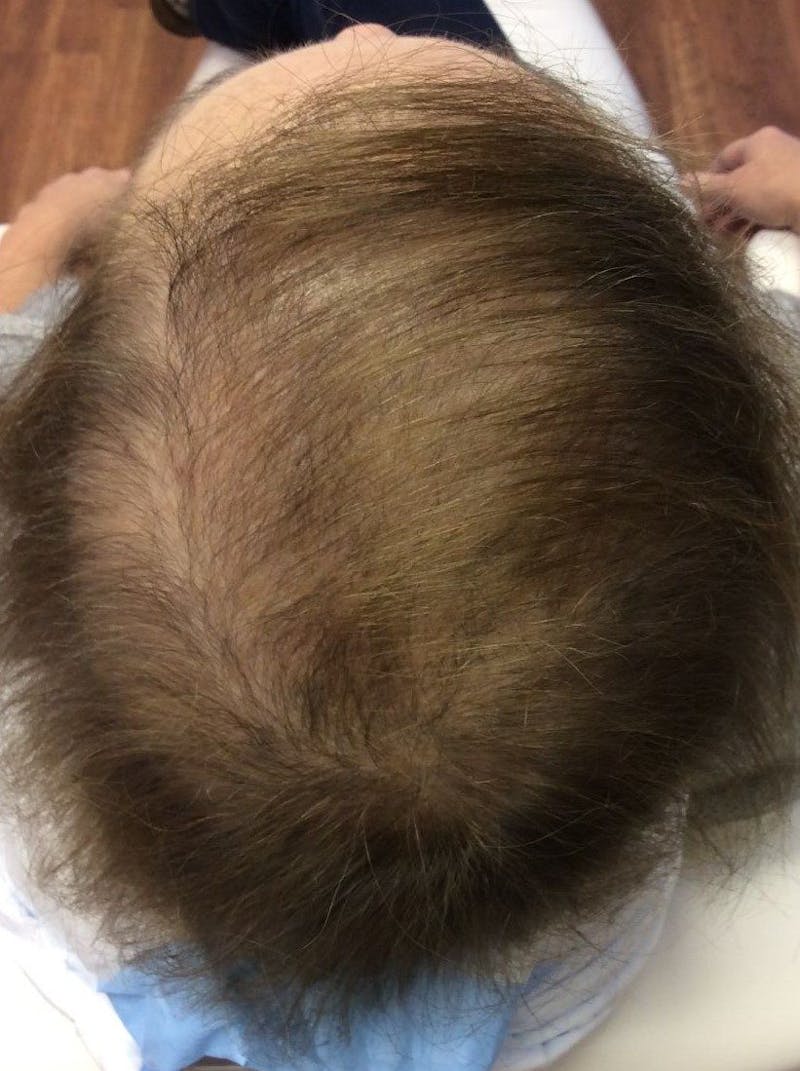Platelet Rich Plasma Therapy Before & After Gallery - Patient 206033 - Image 1