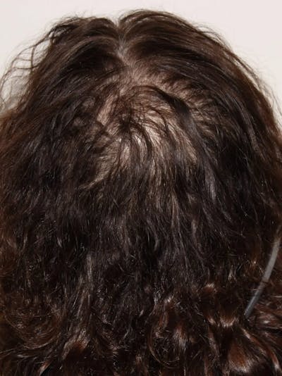 Low Level Laser Therapy Before & After Gallery - Patient 320278 - Image 1