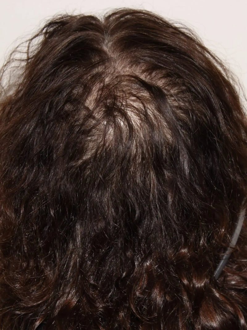 Low Level Laser Therapy Before & After Gallery - Patient 320278 - Image 1
