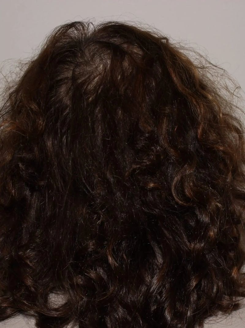 Low Level Laser Therapy Before & After Gallery - Patient 320278 - Image 2