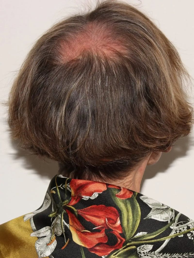 Low Level Laser Therapy Before & After Gallery - Patient 113165 - Image 1