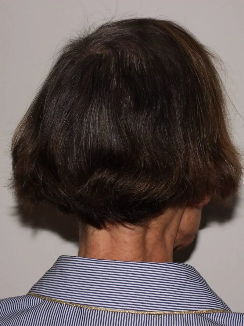 Low Level Laser Therapy Before & After Gallery - Patient 113165 - Image 2
