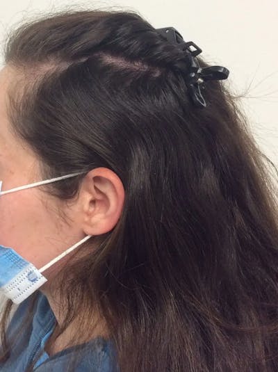 Optimal Platelet Concentration™ Therapy Before & After Gallery - Patient 388380 - Image 1