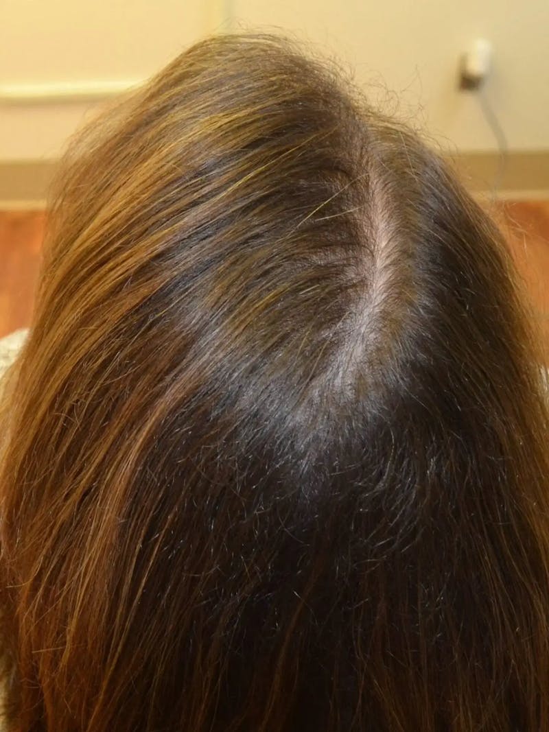Optimal Platelet Concentration™ Therapy Before & After Gallery - Patient 151454 - Image 1