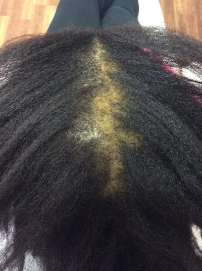 Platelet Rich Plasma Therapy Before & After Gallery - Patient 272386 - Image 1