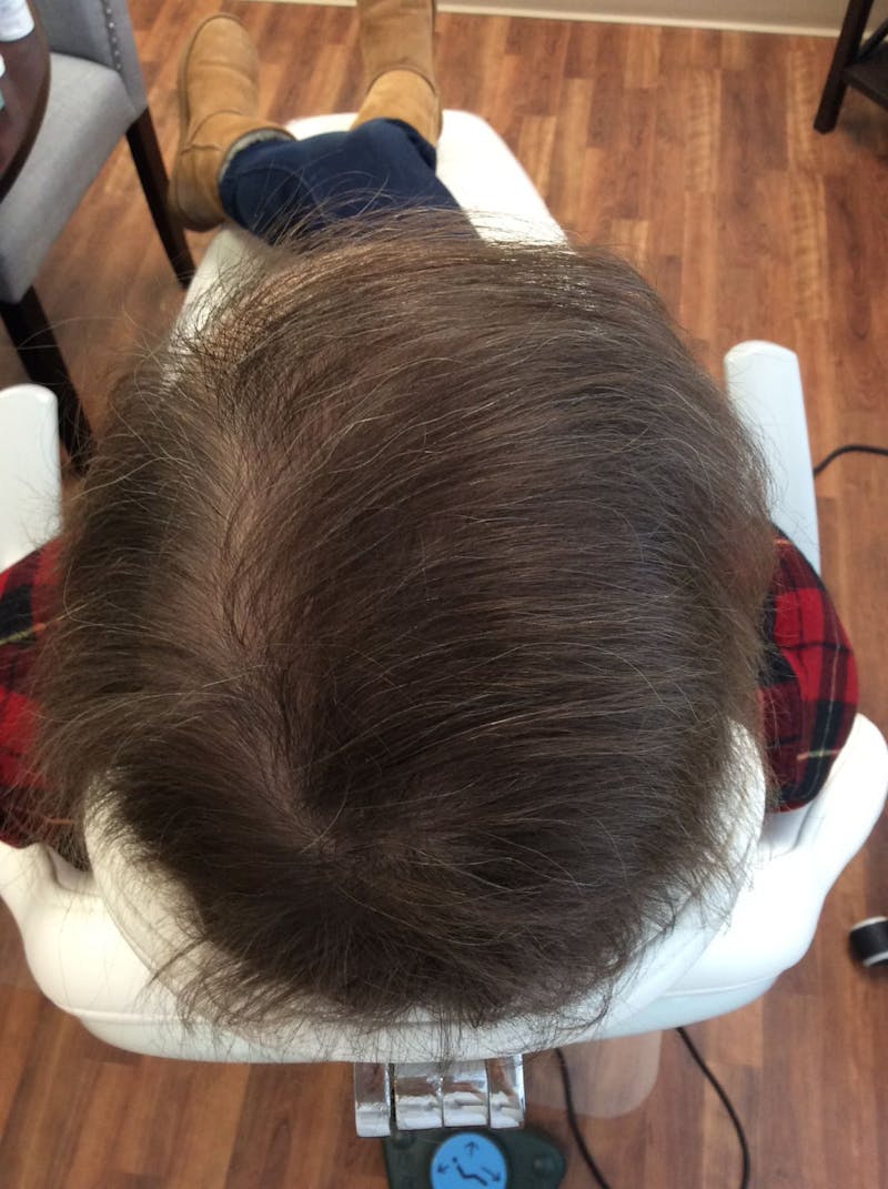 Platelet Rich Plasma Therapy Before & After Gallery - Patient 206033 - Image 2