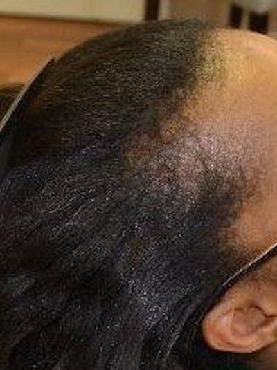 Platelet Rich Plasma Therapy Before & After Gallery - Patient 339010 - Image 1