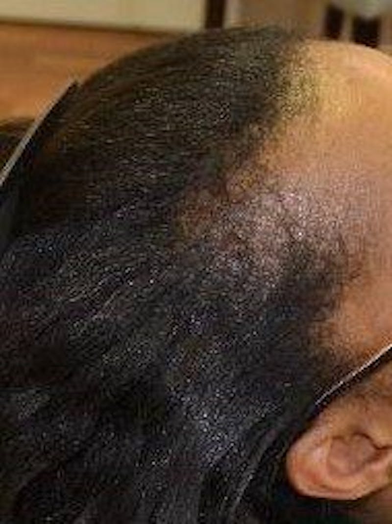 Platelet Rich Plasma Therapy Before & After Gallery - Patient 339010 - Image 1