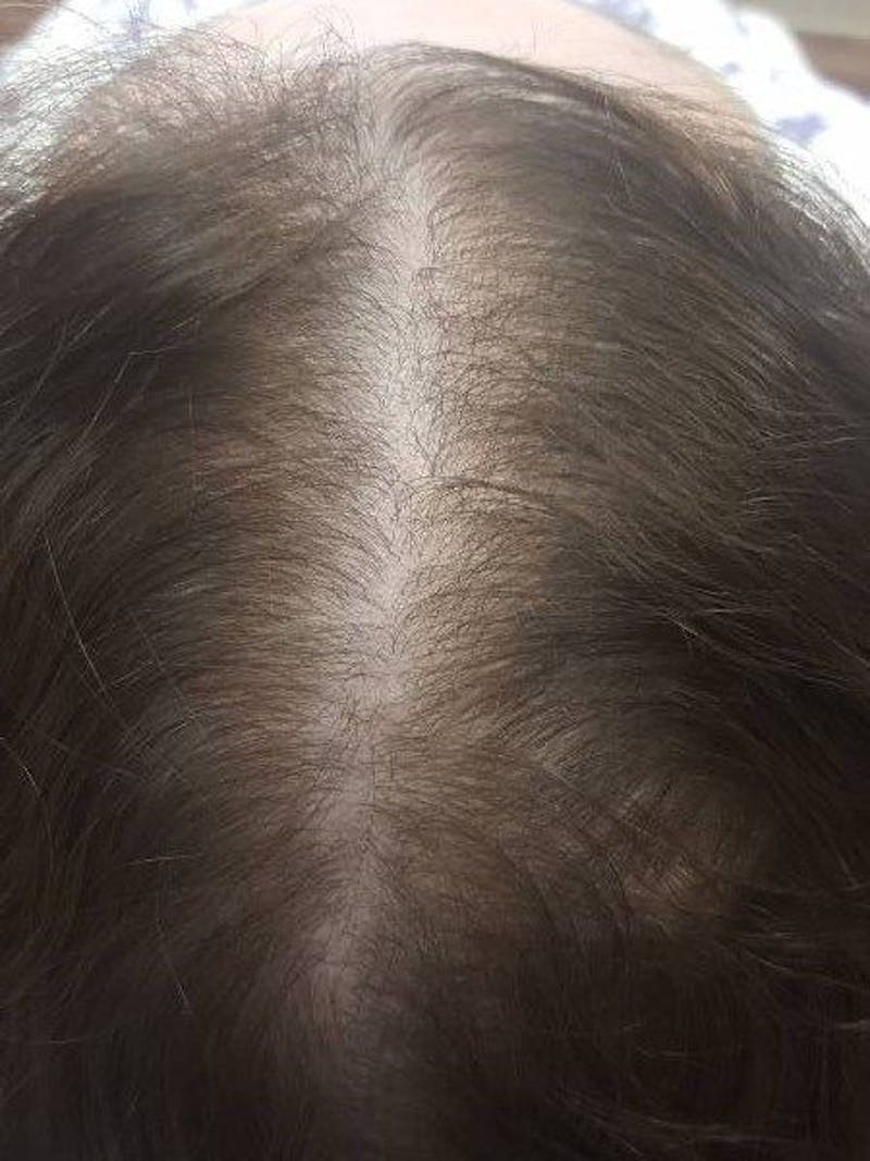 Platelet Rich Plasma Therapy Before & After Gallery - Patient 239213 - Image 1