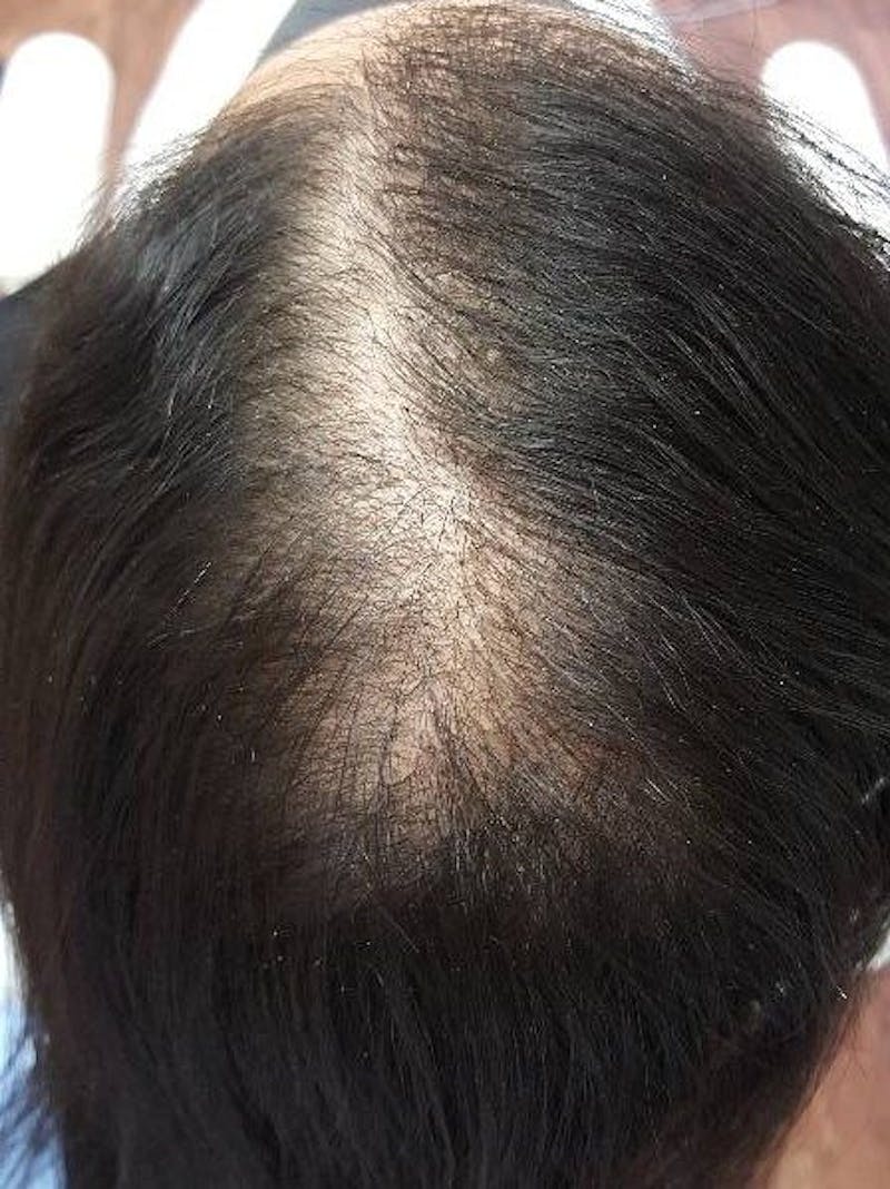Platelet Rich Plasma Therapy Before & After Gallery - Patient 301944 - Image 1