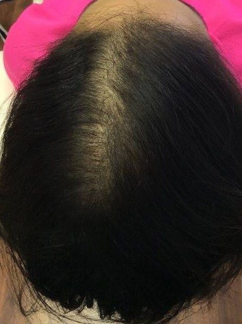 Platelet Rich Plasma Therapy Before & After Gallery - Patient 301944 - Image 2