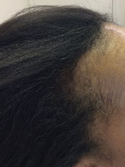 Platelet Rich Plasma Therapy Before & After Gallery - Patient 339010 - Image 2