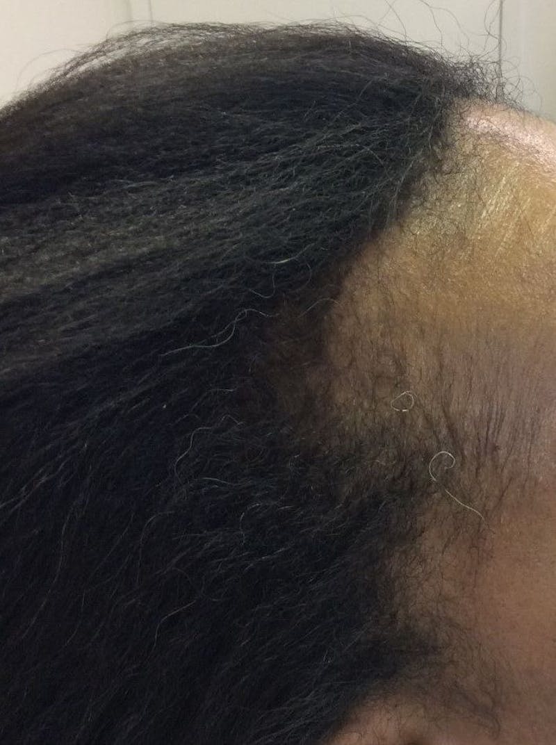 Platelet Rich Plasma Therapy Before & After Gallery - Patient 339010 - Image 2