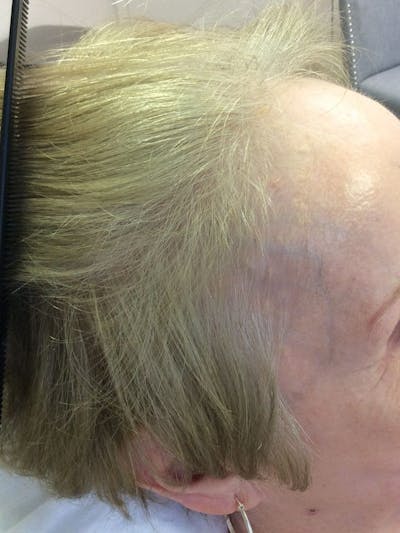 Female Hair Transplants Before & After Gallery - Patient 213214 - Image 1