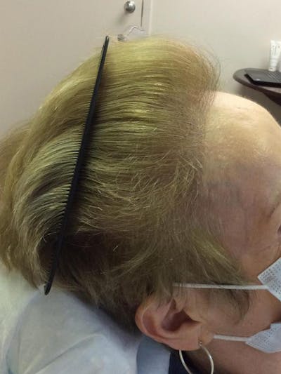 Female Hair Transplants Before & After Gallery - Patient 213214 - Image 2