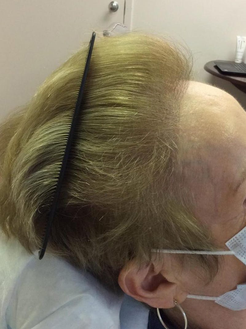 Female Hair Transplants Before & After Gallery - Patient 213214 - Image 2