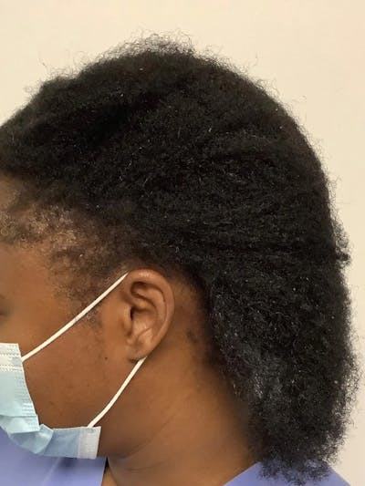 Female Hair Transplants Before & After Gallery - Patient 459703 - Image 2
