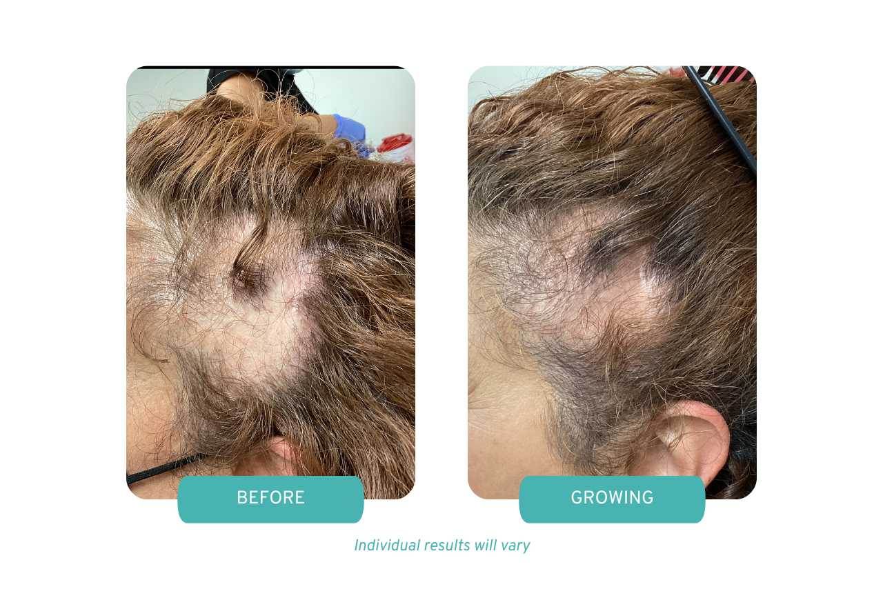 alopecia patient results