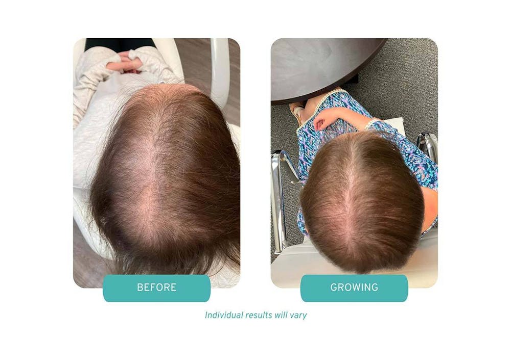 Case study – Painless PRP in Wellesley MA hair regrowth from chemotherapy and radiation