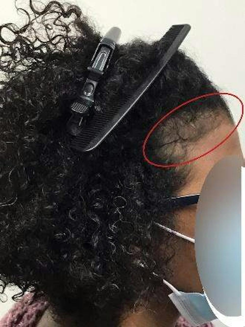 hair restoration patient