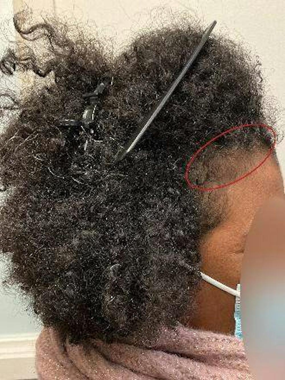 hair restoration patient