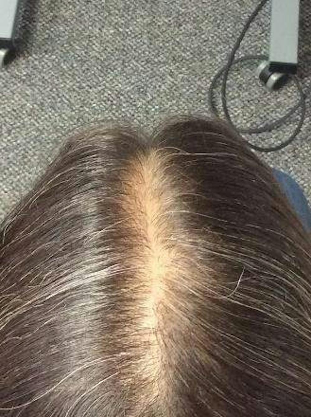 hair restoration patient