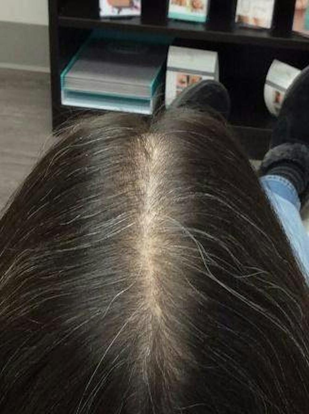 hair restoration patient