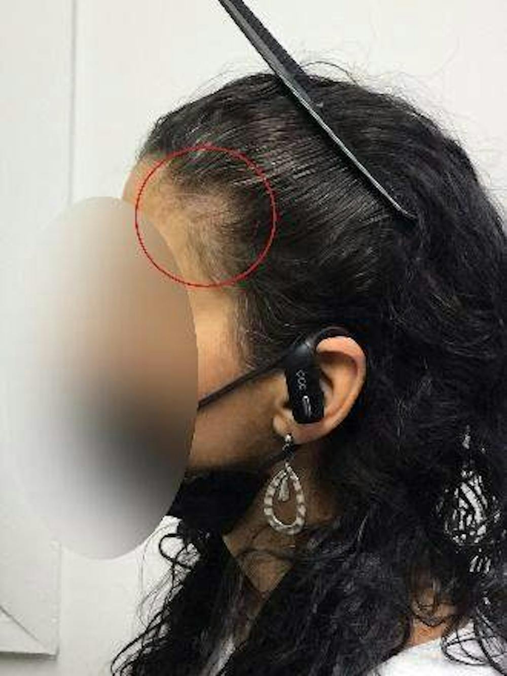 hair restoration patient