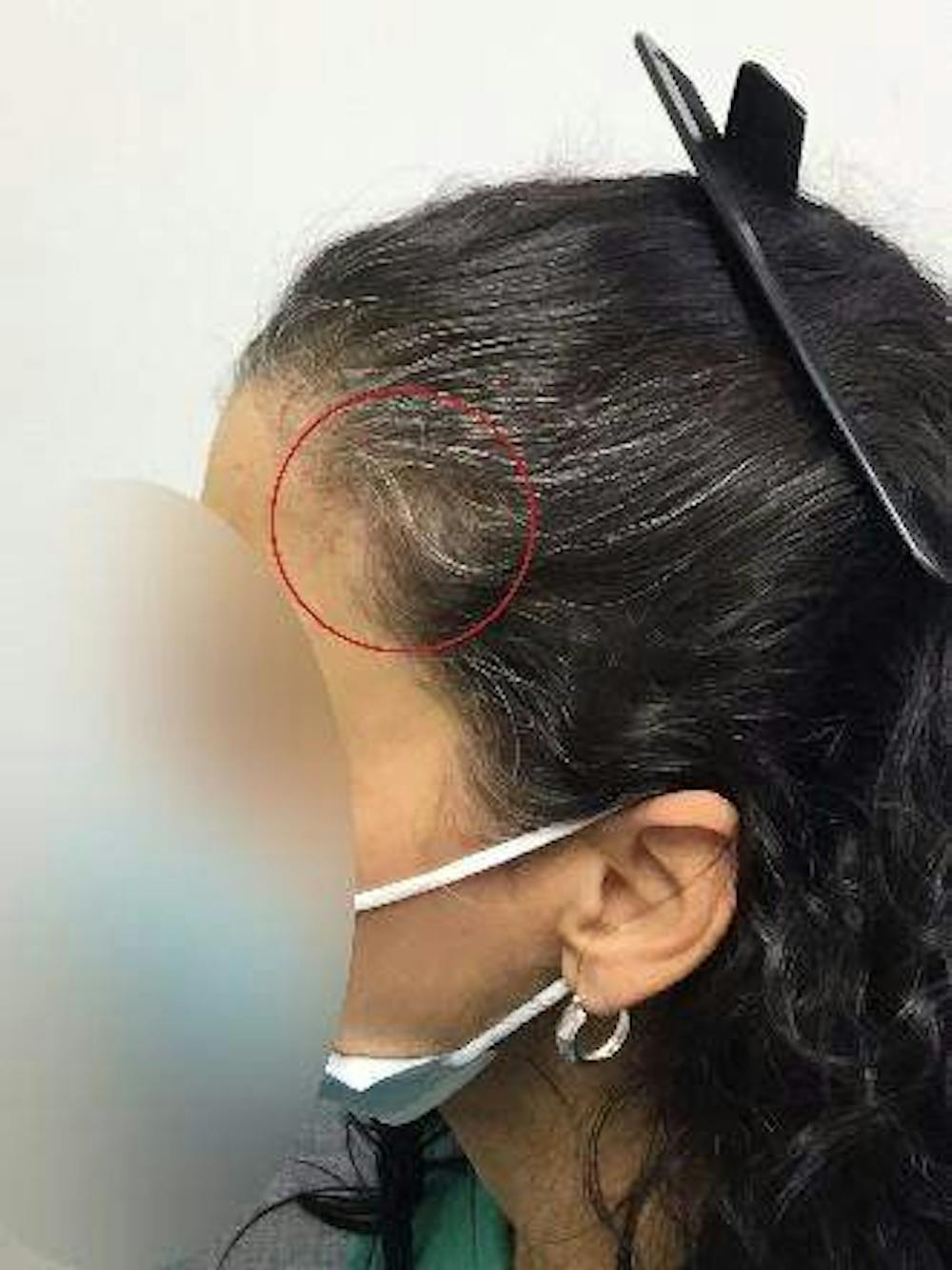 hair restoration patient