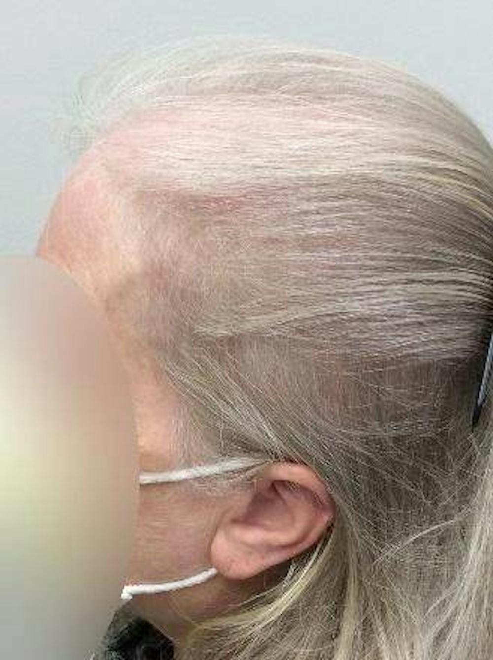 hair restoration patient