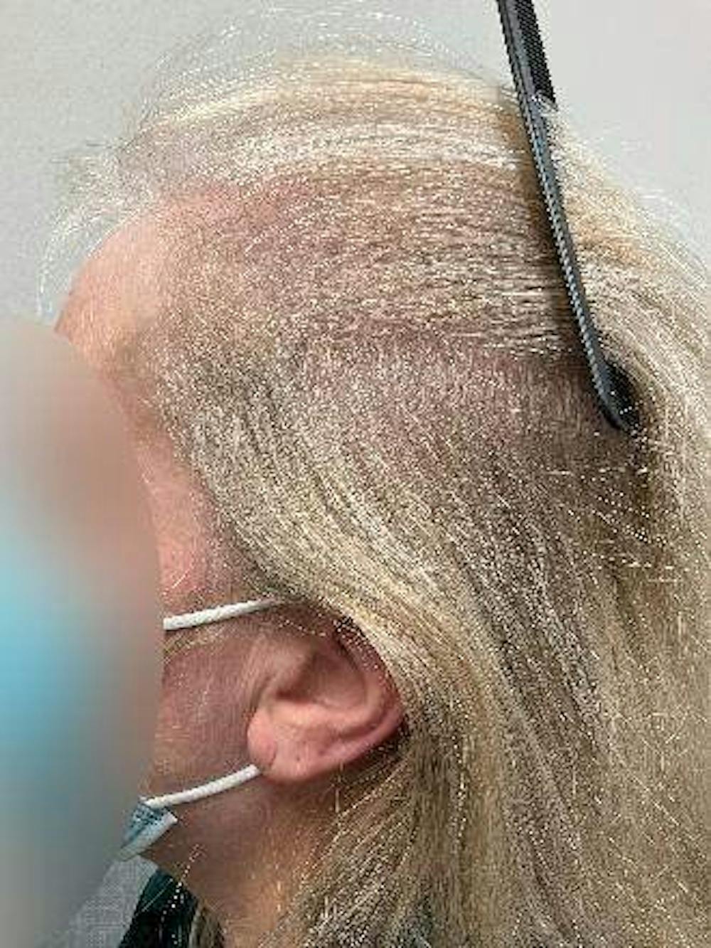 hair restoration patient