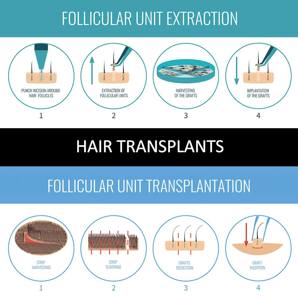 hair transplant infographic