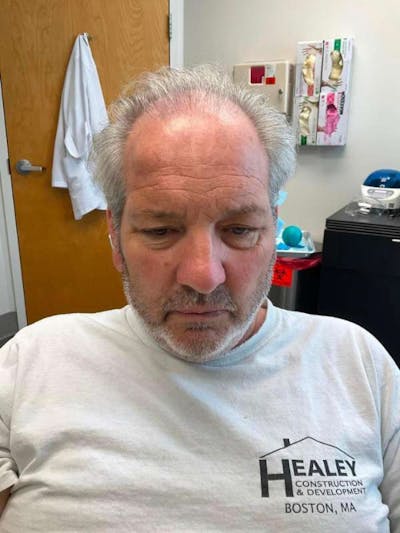 Male Hair Transplants Before & After Gallery - Patient 718874 - Image 1