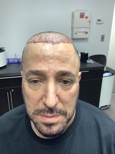 Male Hair Transplants Before & After Gallery - Patient 262867 - Image 1