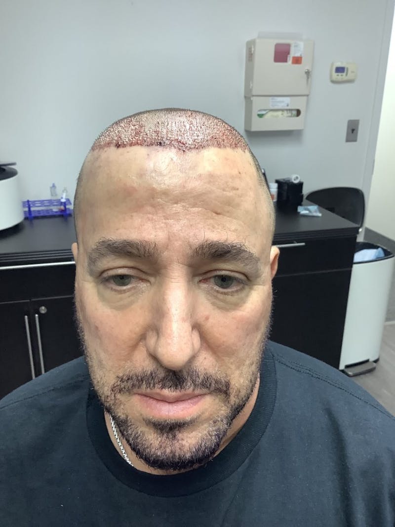 Male Hair Transplants Before & After Gallery - Patient 262867 - Image 1