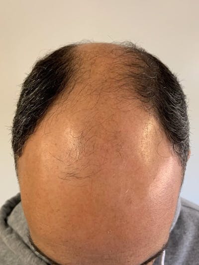 Male Hair Transplants Before & After Gallery - Patient 158161 - Image 1