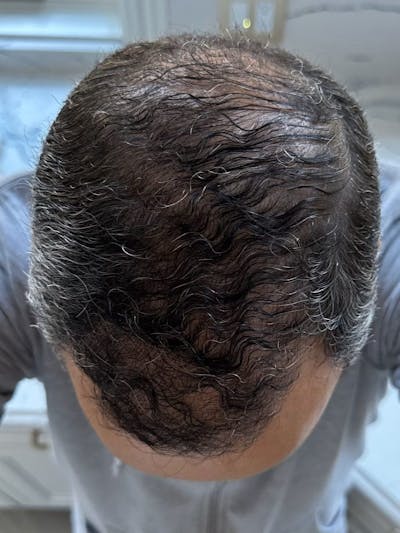 Male Hair Transplants Before & After Gallery - Patient 158161 - Image 2