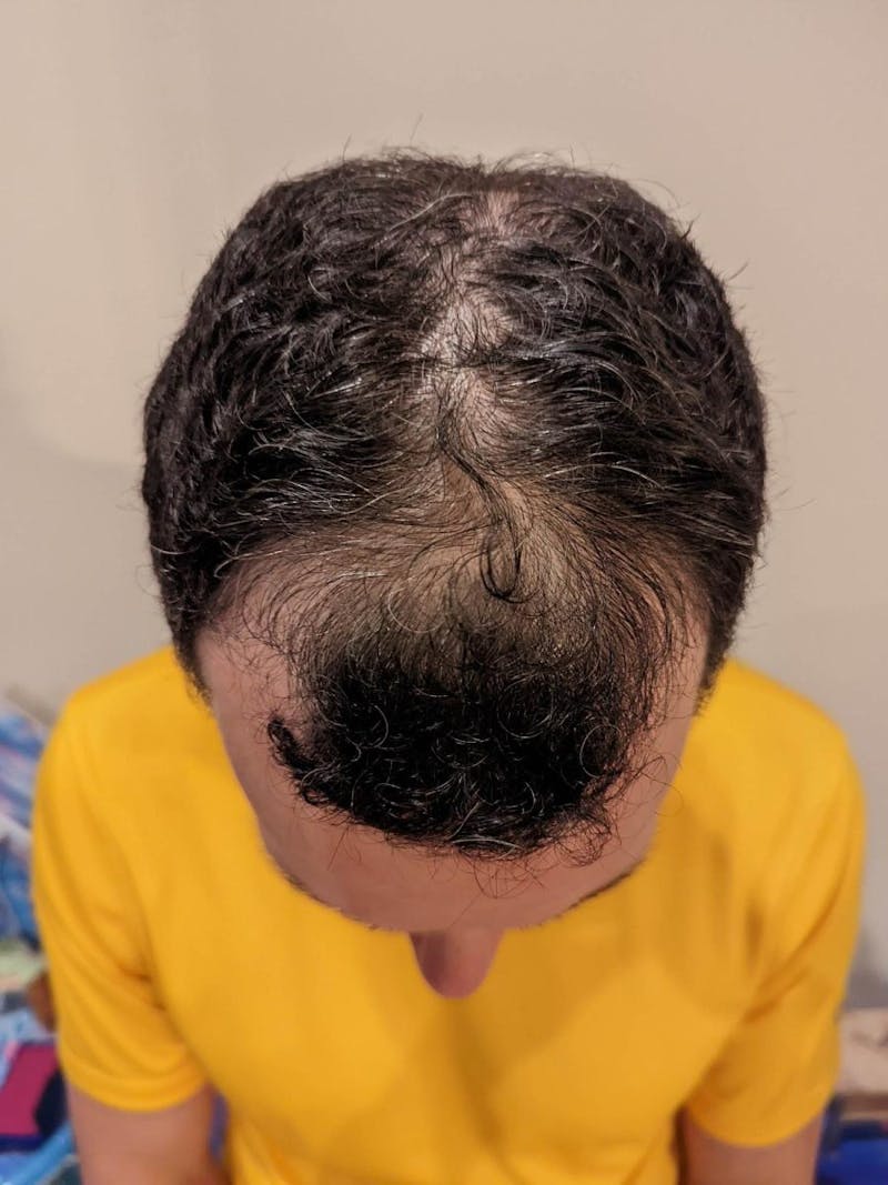 Male Hair Transplants Before & After Gallery - Patient 506325 - Image 1
