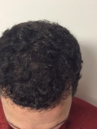 Male Hair Transplants Before & After Gallery - Patient 506325 - Image 2