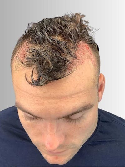 Male Hair Transplants Before & After Gallery - Patient 989121 - Image 1