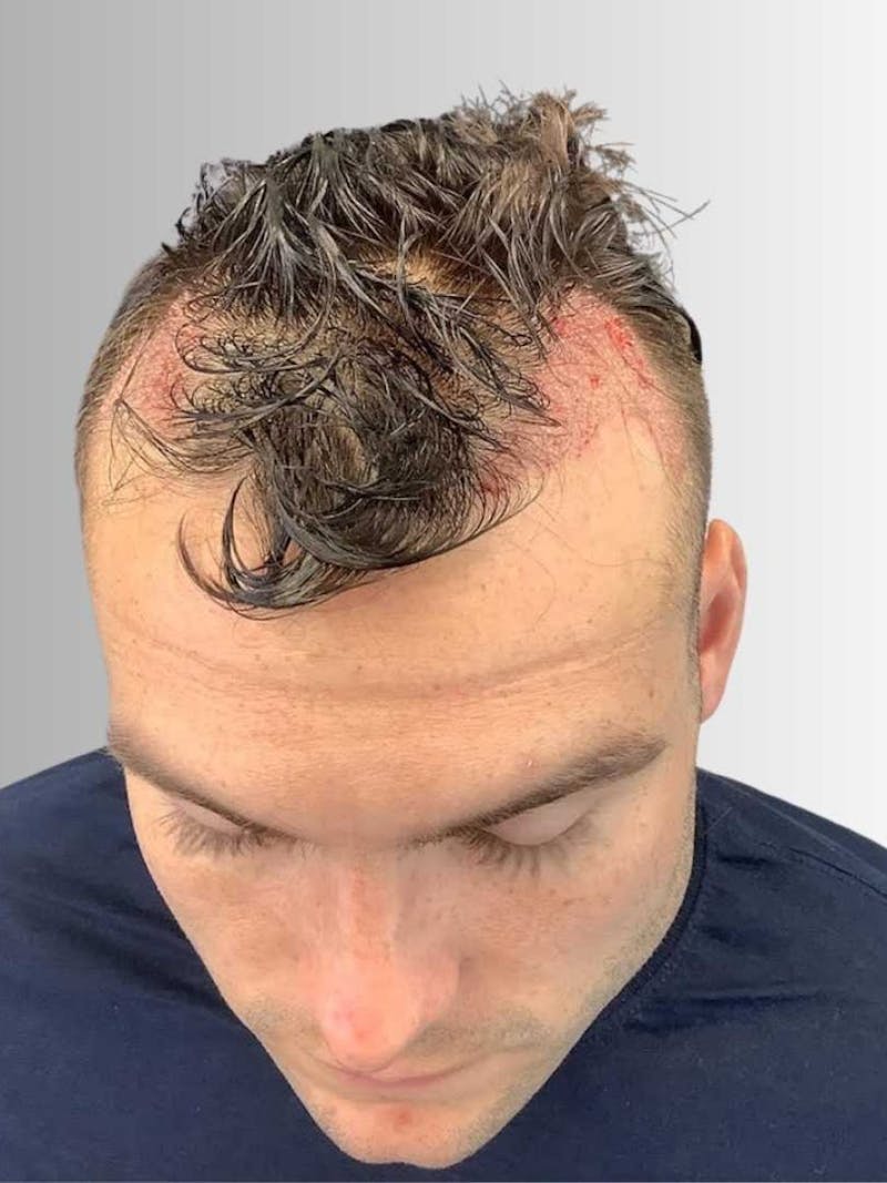 Male Hair Transplants Before & After Gallery - Patient 989121 - Image 1