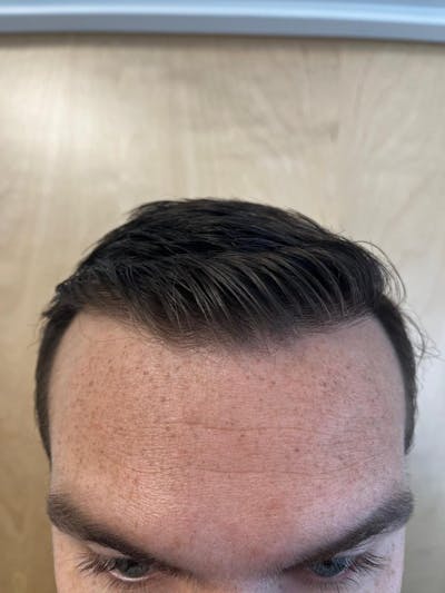Male Hair Transplants Before & After Gallery - Patient 989121 - Image 2
