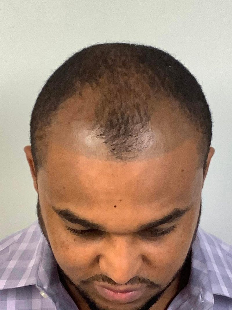 Male Hair Transplants Before & After Gallery - Patient 219254 - Image 1
