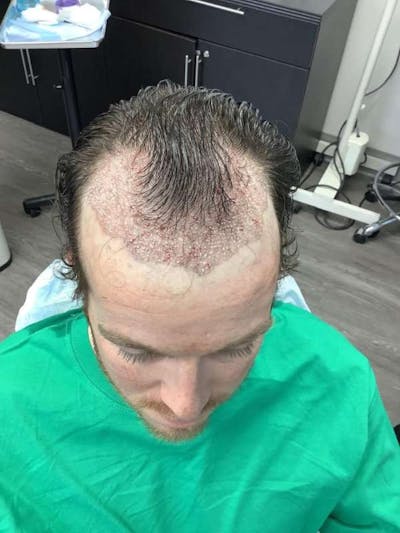Male Hair Transplants Before & After Gallery - Patient 385476 - Image 1