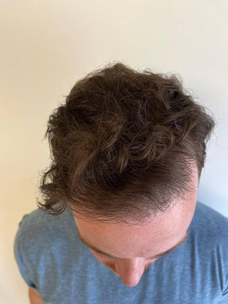 Male Hair Transplants Before & After Gallery - Patient 385476 - Image 2