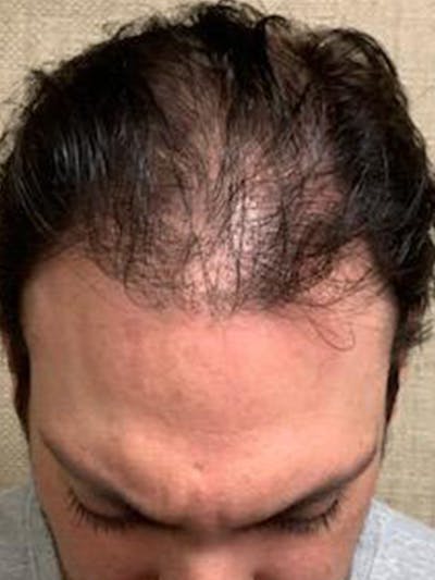 Male Hair Transplants Before & After Gallery - Patient 121391 - Image 1