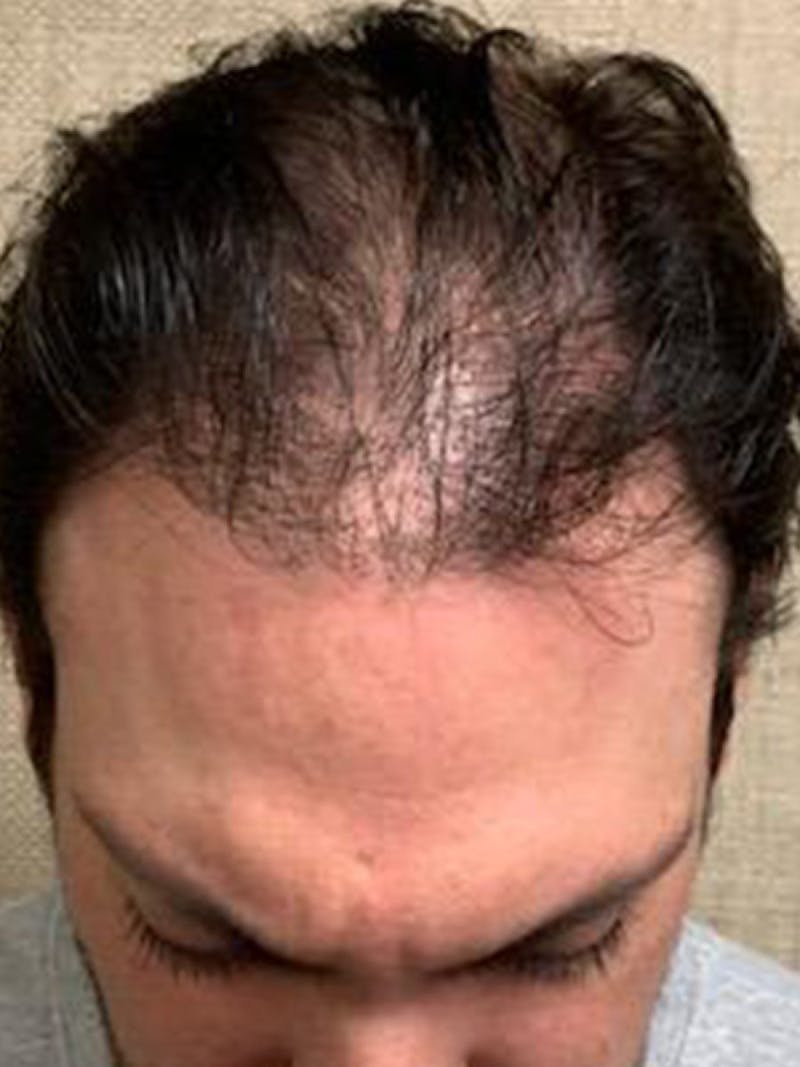 Male Hair Transplants Before & After Gallery - Patient 121391 - Image 1