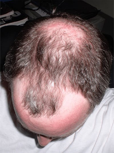 Male Hair Transplants Before & After Gallery - Patient 290169 - Image 1