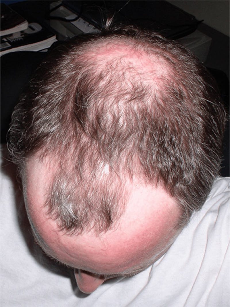 Male Hair Transplants Before & After Gallery - Patient 290169 - Image 1