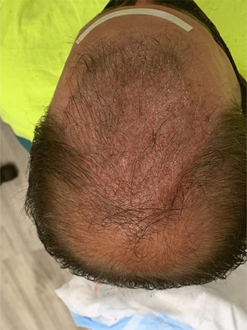 Male Hair Transplants Before & After Gallery - Patient 108592 - Image 1